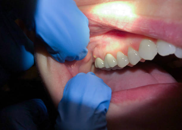 Best Dental Abscess Treatment in Altoona, IA